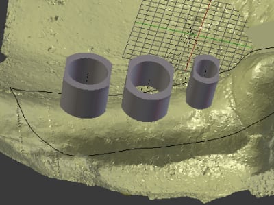 Drill sleeves bfapfe - Eugenol