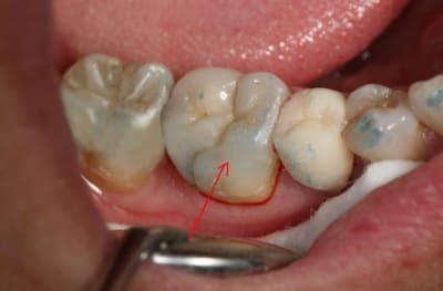 Dudule blanc yr3ebu - Eugenol