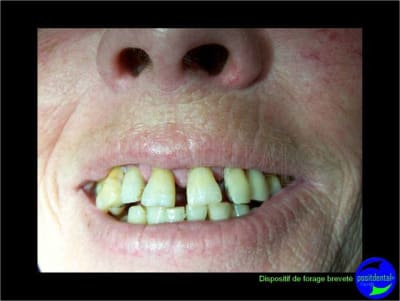 Eimci et canine incluse positdental 06 u3dztq - Eugenol