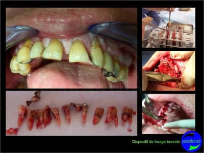 Eimci et canine incluse positdental 07 uftivz - Eugenol
