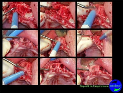 Eimci et canine incluse positdental 08 pexaib - Eugenol