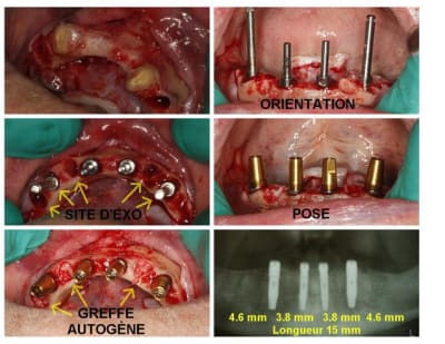 Exo 4 implants  custom  jerhk0 - Eugenol