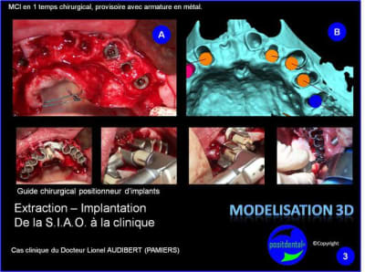 Extraction   implantation   mod lisation 3d positdental  11 wodrxy - Eugenol