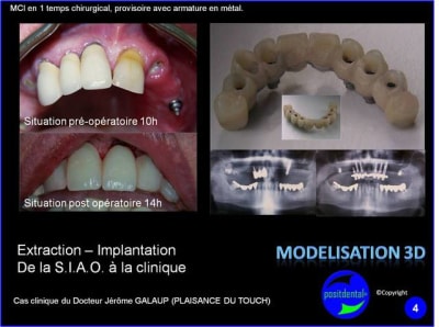 Extraction   implantation   mod lisation 3d positdental  12 dnhnvn - Eugenol