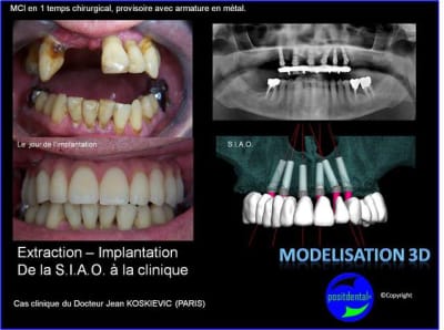 Extraction   implantation   mod lisation 3d positdental  1 gzgm3h - Eugenol