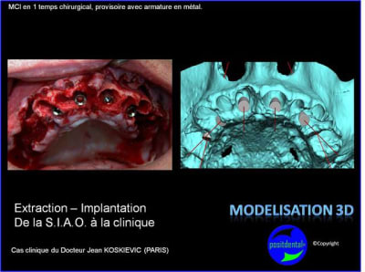 Extraction   implantation   mod lisation 3d positdental  8 glbcnu - Eugenol