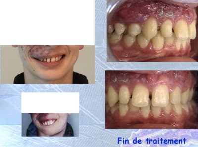 Franc apres tbl5ct - Eugenol