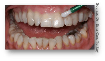 Gc mi varnish 2 sfscf0 - Eugenol