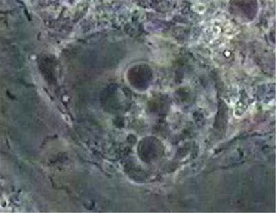 Gun avec amibes  spirochètes et fusospirilles zoom spfp8r - Eugenol