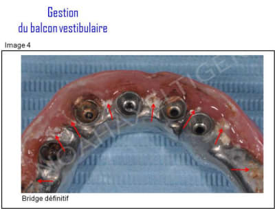 Gestion du balcon vestibulaire 4 k1unrp - Eugenol