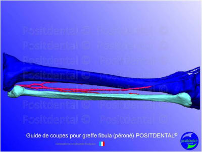 Guide de coupes pour greffe fibula  p ron   positdental 005 kfg2yq - Eugenol