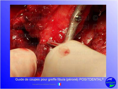 Guide de coupes pour greffe fibula  p ron   positdental 026 xdksau - Eugenol