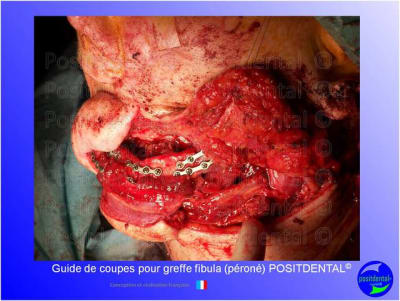 Guide de coupes pour greffe fibula  p ron   positdental 032 msphu2 - Eugenol