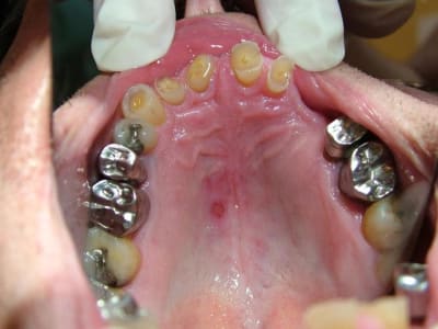 Haut faces occlusales 1 e7tnt3 - Eugenol