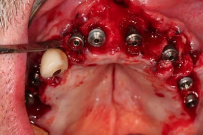 Img implants l7t0rq - Eugenol
