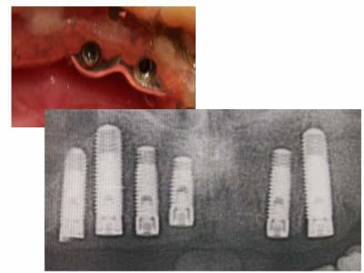 Implants dfed5o - Eugenol