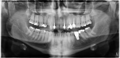 Implant ceram hucrhy - Eugenol