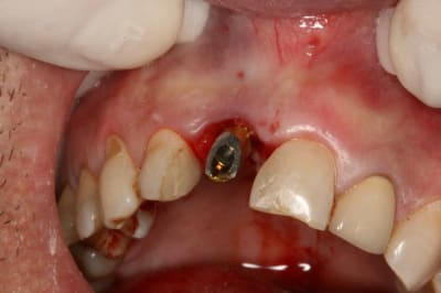 Implant dent 11 004 d6n4pz - Eugenol