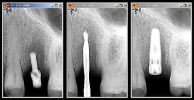 Implant 25 v8spz1 - Eugenol