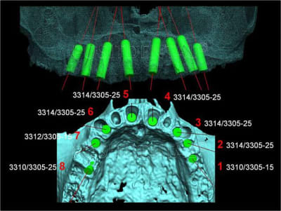 Implant l one et mci post extrationnelle  mcipe 002 y8ur4t - Eugenol