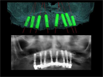 Implant l one et mci post extrationnelle  mcipe 003 y7s73u - Eugenol