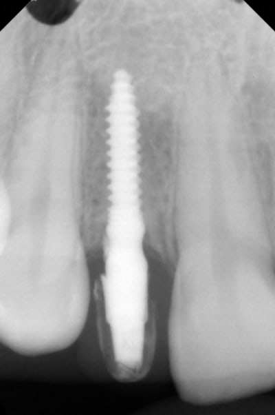 Implant osstem yzwktm - Eugenol