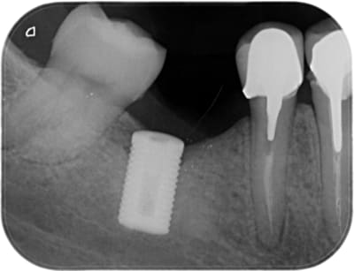 Implant xmap8z - Eugenol