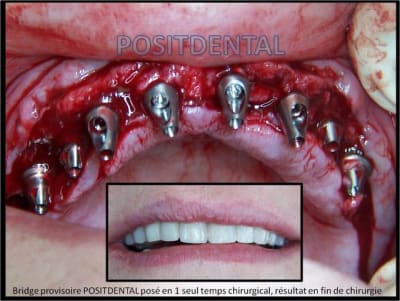 Implants astra mise en charge imm diate hxlpkw - Eugenol