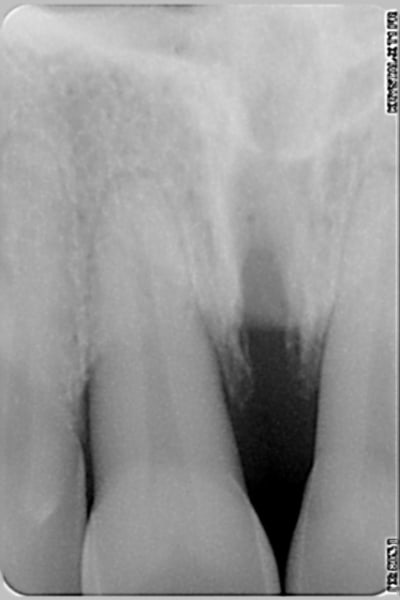 Incisives d h 1 udffqi - Eugenol