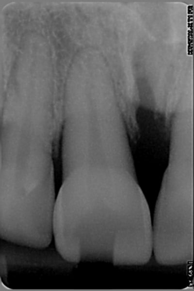 Incisives d h 2 eb7bgy - Eugenol