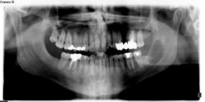 Kyste angle be2brg - Eugenol