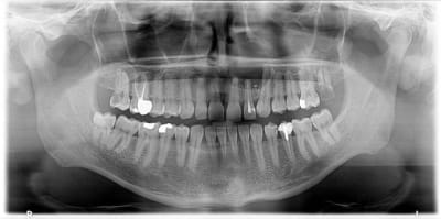 Kyste vcmttl - Eugenol