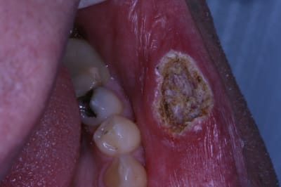 Laser levre inf gauche 006 gsm7ha - Eugenol