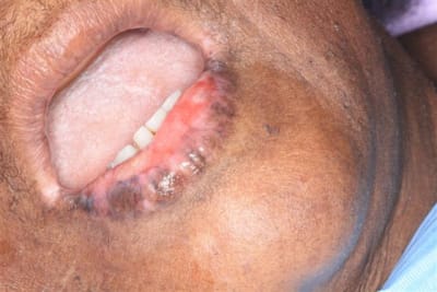 Lesions labiales 001  small  sojhnv - Eugenol