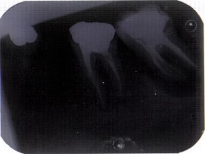 Lastscan grosse image apicale  aaqtnm - Eugenol