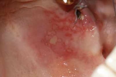 Lesion1 o4vk2c - Eugenol