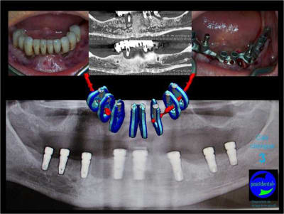 Mcd mise en charge diff r e07 vp9ksd - Eugenol