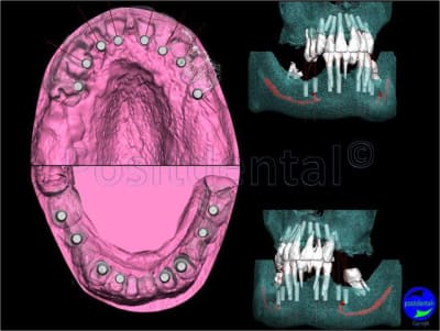 Mcipe bi maxillaire du 13 f vier 2012 004 mukfy0 - Eugenol
