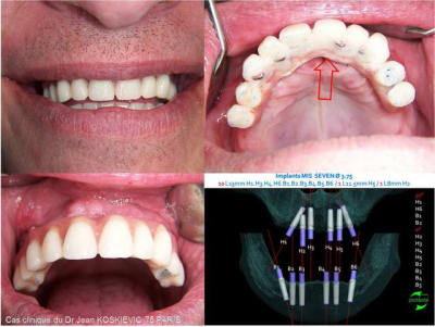 Mci guide chirurgical positdental up9lo5 - Eugenol