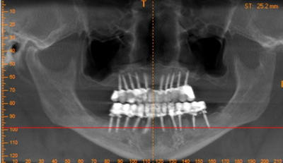 Mini implants case s39to3 - Eugenol