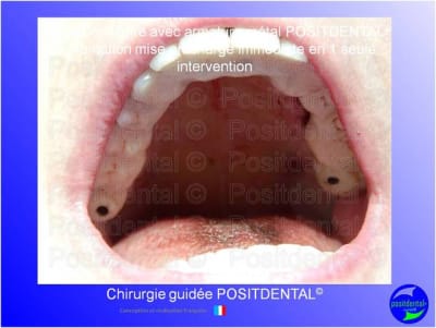 Mise en chage imm diate 167 rf051b - Eugenol