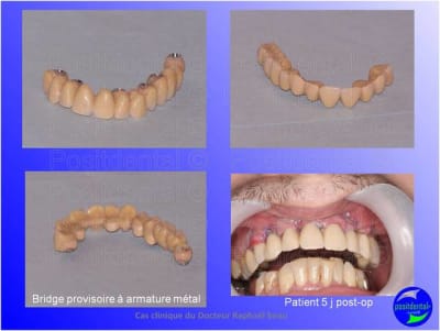 Mise en chage imm diate 187 axkqjr - Eugenol