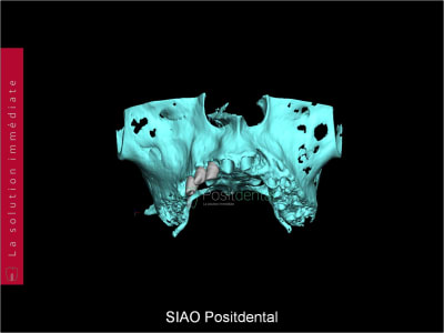 Mise en charge immédiate   chirurgie guidée guide chirurgical a 003 rsbwp6 - Eugenol