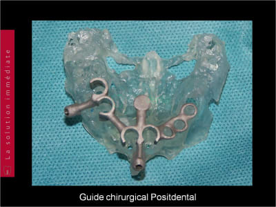 Mise en charge immédiate   chirurgie guidée guide chirurgical a 004 sd0eou - Eugenol