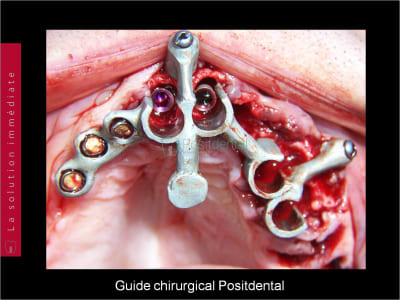 Mise en charge immédiate   chirurgie guidée guide chirurgical a 006 w4pbwr - Eugenol