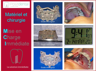 Mise en charge immédiate 005 ulious - Eugenol