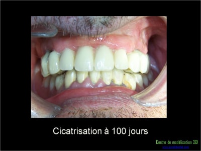 Mise en charge immédiate implant dentaire 010 mlttjw - Eugenol