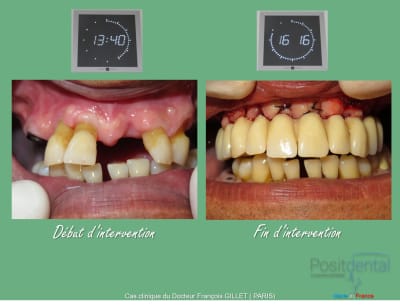 Misen en charge immédiate implants et dents en 1 seule intervention 002 gbi4hi - Eugenol
