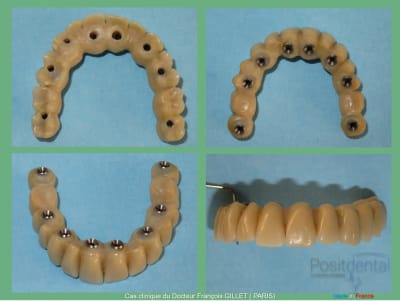Misen en charge immédiate implants et dents en 1 seule intervention 006 dp5adl - Eugenol