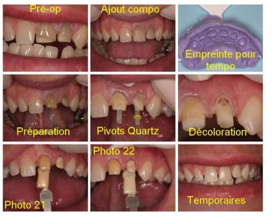 Montage pr paration notes  custom  kxftmw - Eugenol